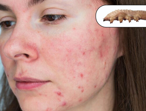 Demodex és rosacea kezelése- hogyan törjük meg a gyulladás körét?